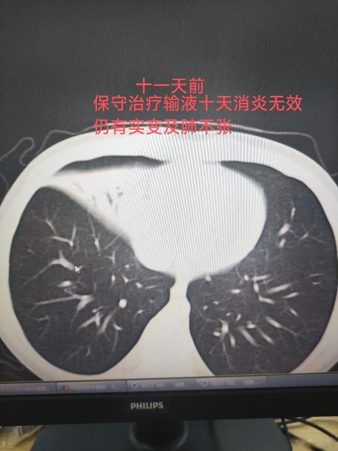 大连肺炎病例,大连肺炎最新消息2020-第2张图片