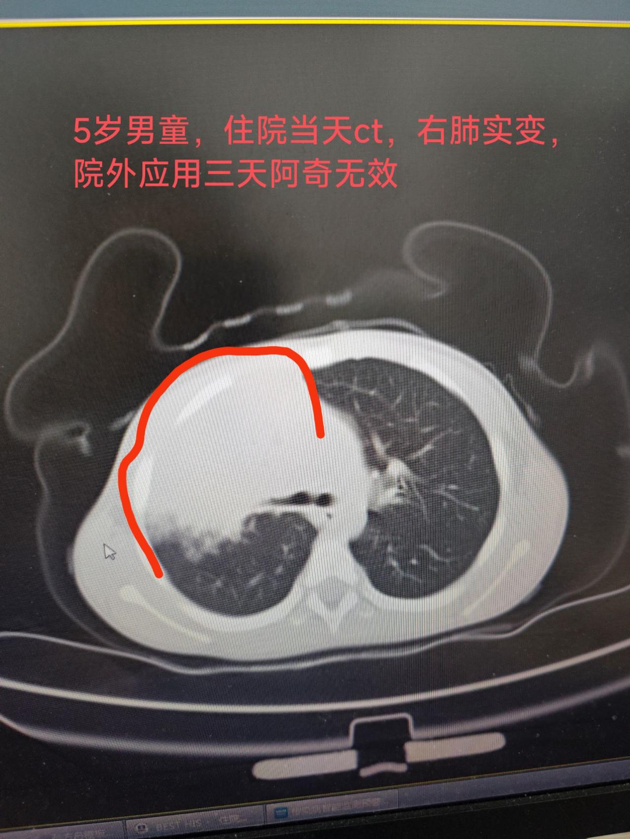 【新疆肺炎/新疆确诊肺炎】